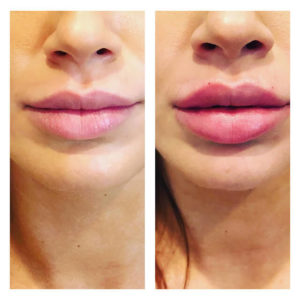 Before and After Image of Lower Face Treatment By GloDerma Aesthetics in Yardley, PA