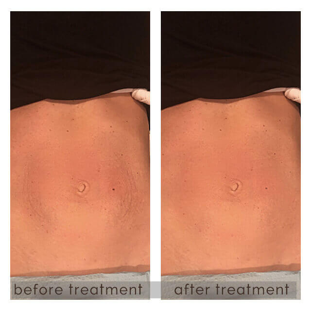 Before and After Image of Nova Threads Treatment | GloDerma Aesthetics in Yardley, PA
