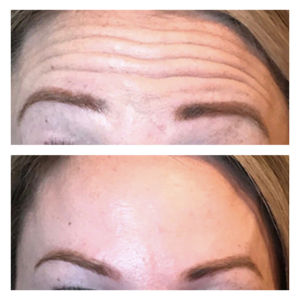 Before and After Image of Botox Treatment By GloDerma Aesthetics in Yardley, PA