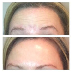 Before and After Image of Dysport Treatment By GloDerma Aesthetics in Yardley, PA