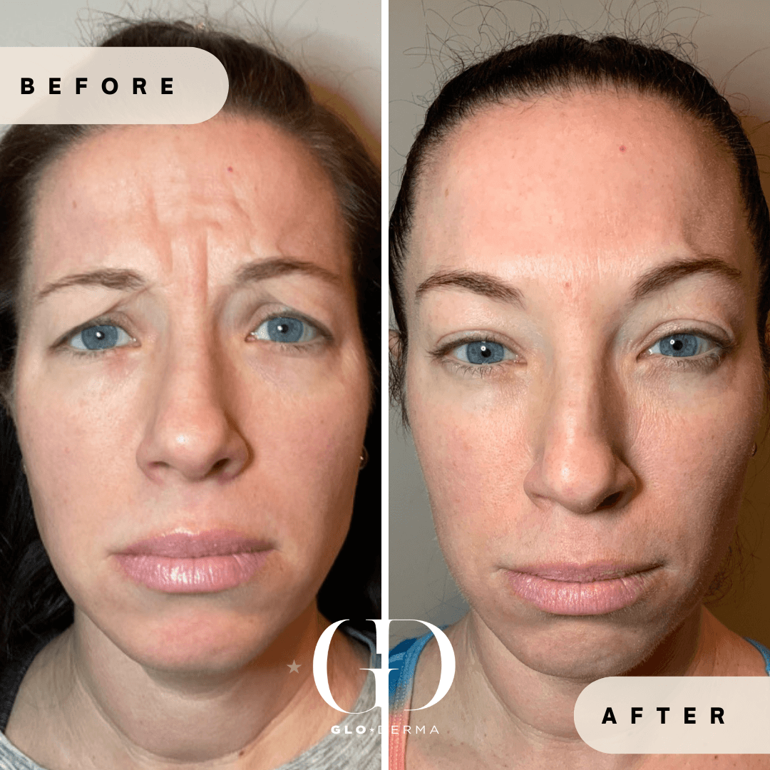 Before and After Image of Botox Dysport Treatment By GloDerma Aesthetics in Yardley, PA