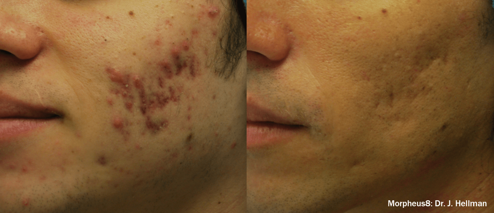 Before and After Image of Morpheus8 Treatment By GloDerma Aesthetics in Yardley, PA