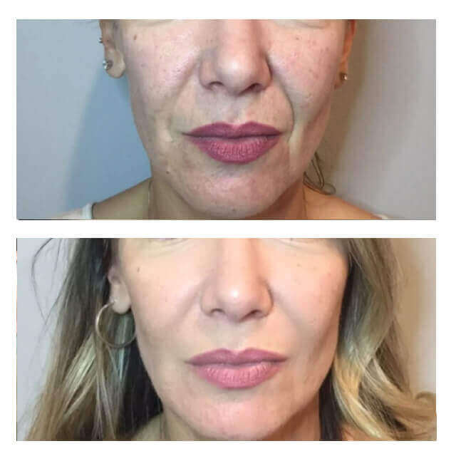 Before and After Image of PRP PRF Treatments By GloDerma Aesthetics in Yardley, PA