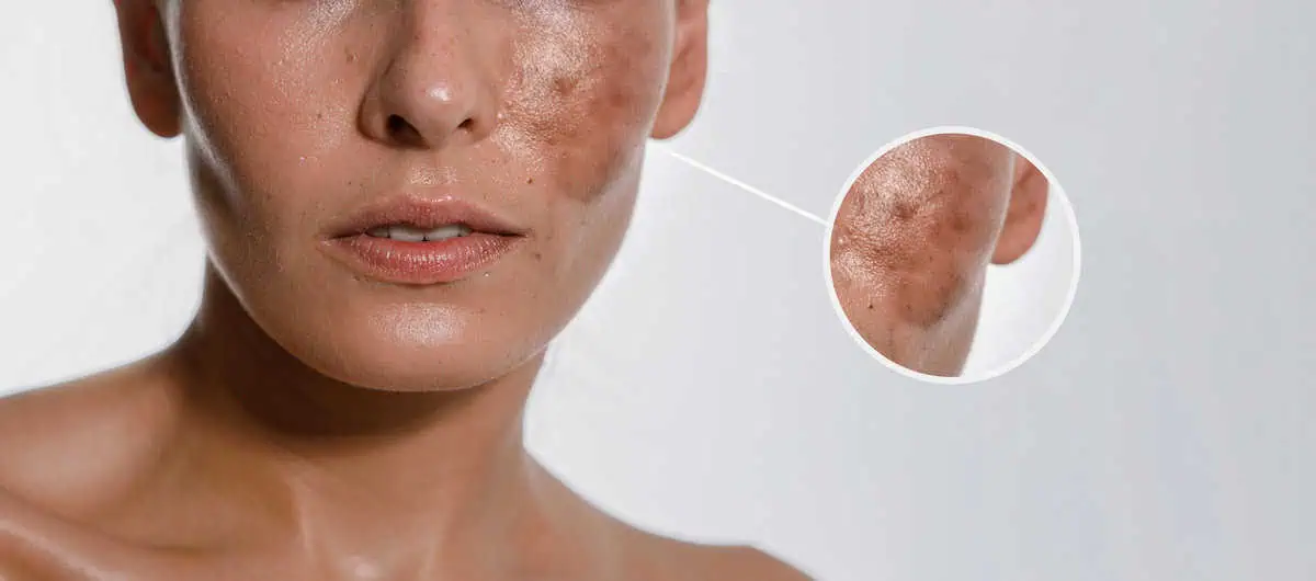 Sun Damage and Hyperpigmentation | Yardley PA | GLO Medical Facials