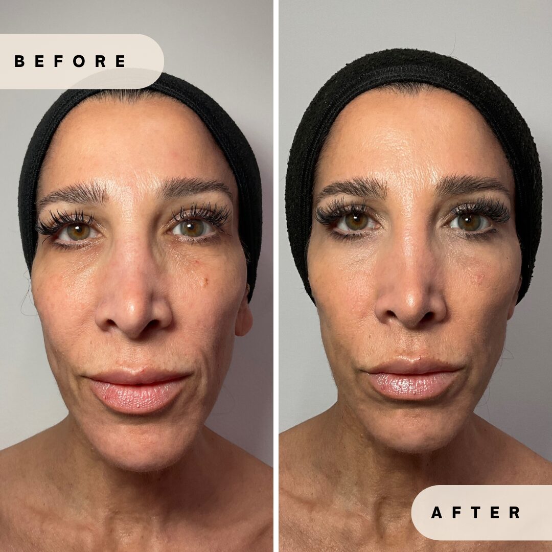 Collagen Threads Before and After Results at Glo Derma Yardley, PA