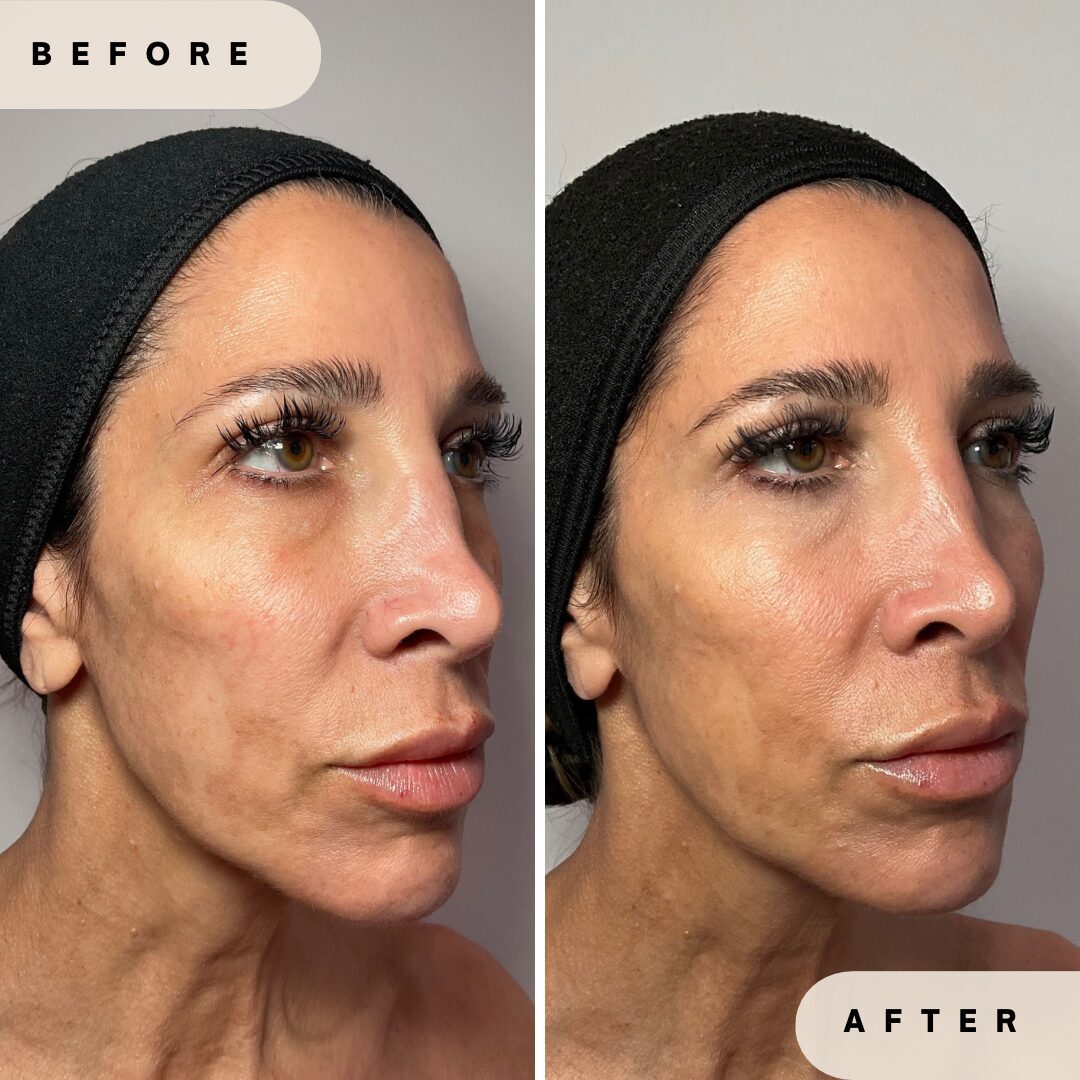Collagen Threads Before and After Results at Glo Derma Yardley, PA