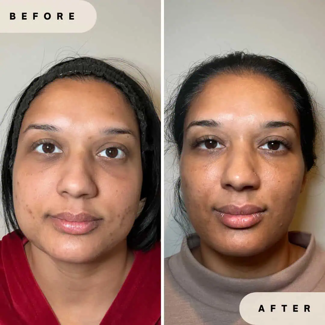 Platelet-Derived Growth Factor (PDGF) Before and After Results at Glo Derma Yardley, PA