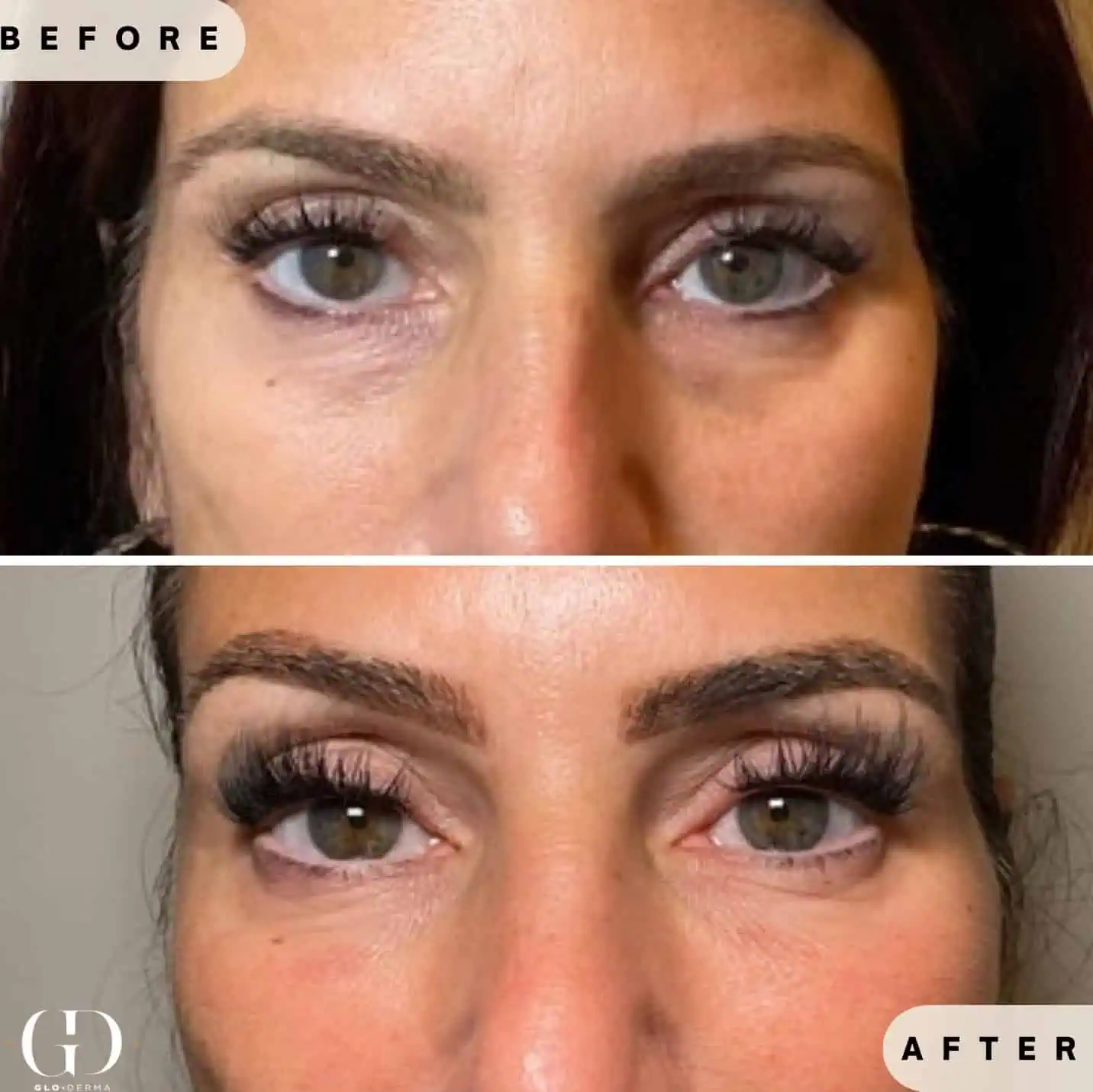 Platelet-Derived Growth Factor (PDGF) Before and After Results at Glo Derma Yardley, PA