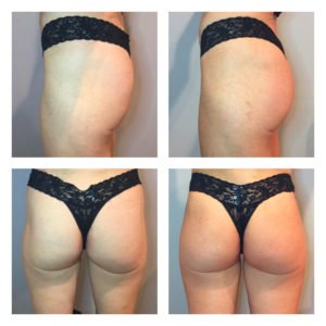 Before and After Image of Booty Enhancement Treatment By GloDerma Aesthetics in Yardley, PA