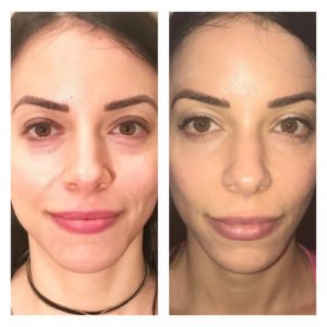 Before and After Image of Signature Treatments By GloDerma Aesthetics in Yardley, PA