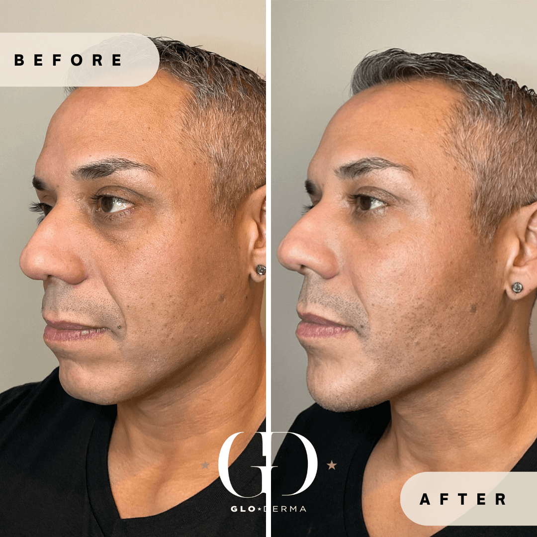 Before and After Image of Facial Harmonization Treatment By GloDerma Aesthetics in Yardley, PA