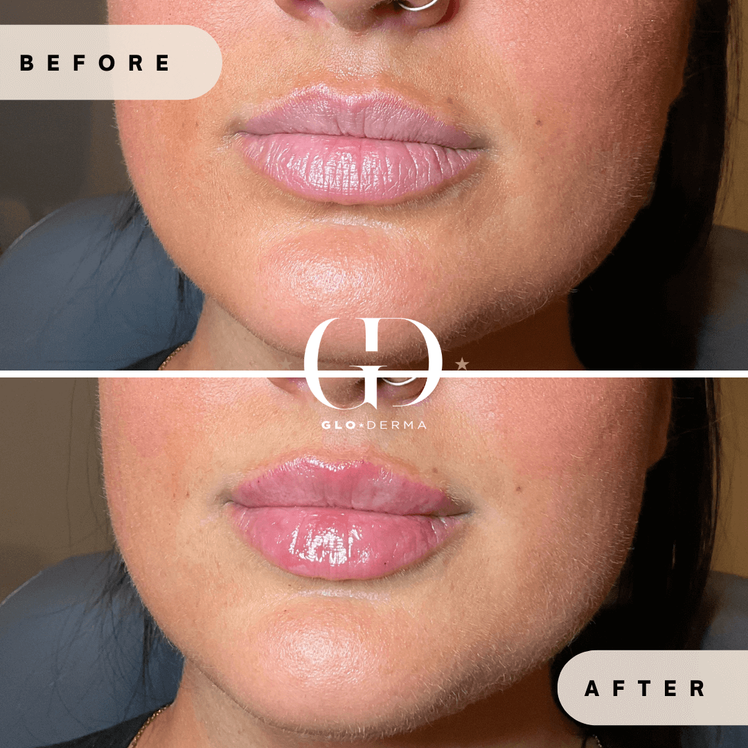 Before and After Image of Lips Treatment By GloDerma Aesthetics in Yardley, PA