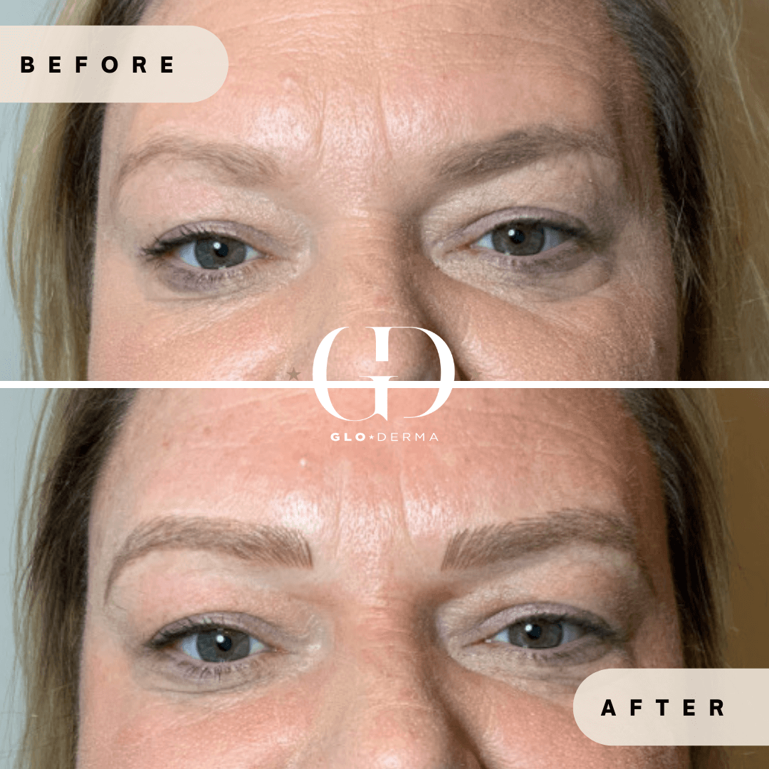 Before and After Image of Microblading Treatment By GloDerma Aesthetics in Yardley, PA