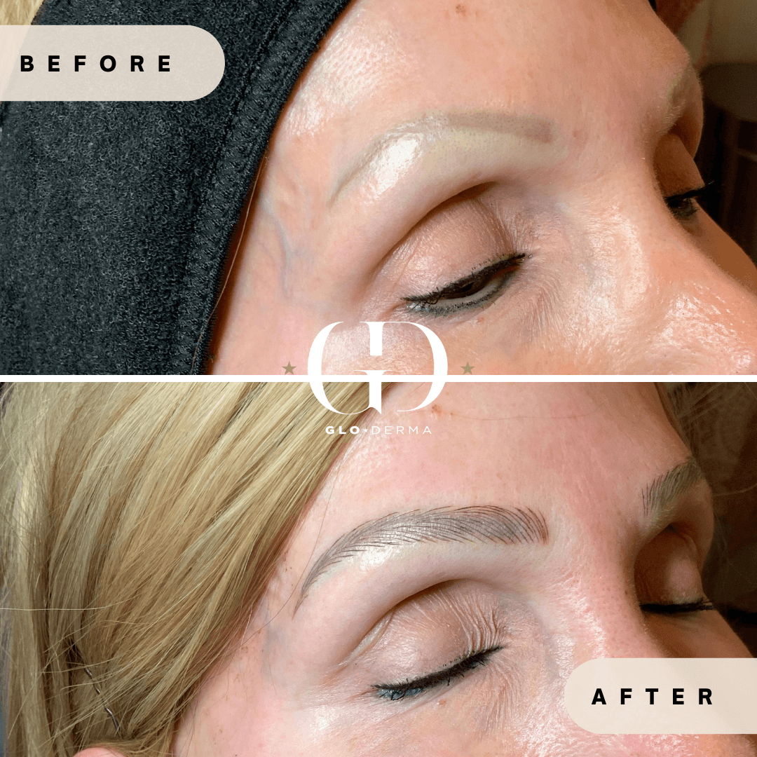 Before and After Image of Microblading Treatment By GloDerma Aesthetics in Yardley, PA