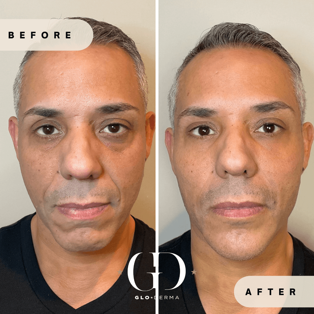 Before and After Image of Dermal Filler Treatment By GloDerma Aesthetics in Yardley, PA