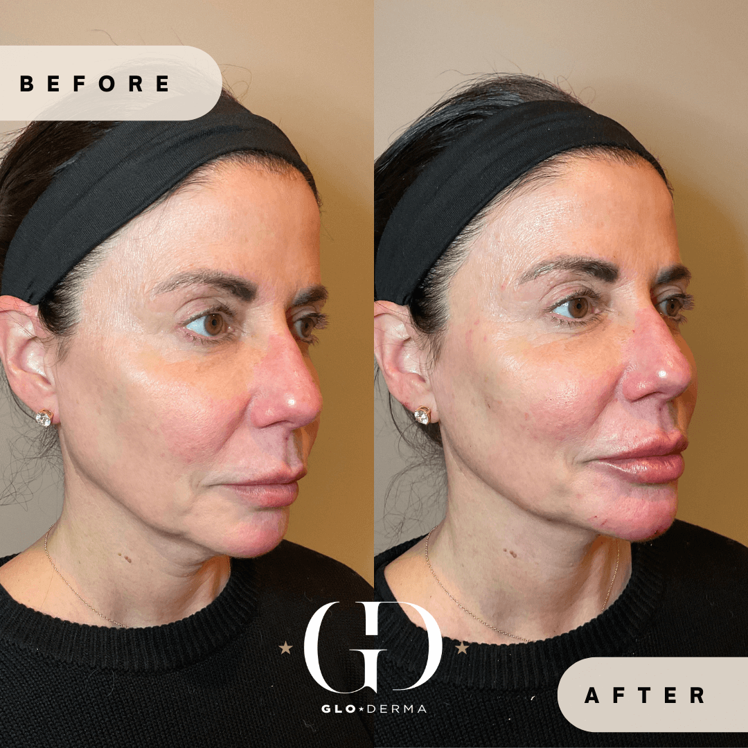 Before and After Image of Lower Face Treatment By GloDerma Aesthetics in Yardley, PA