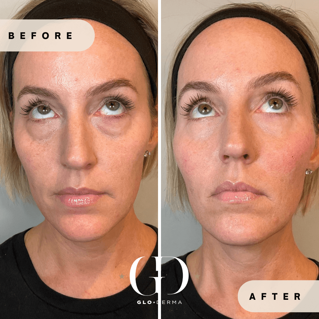 Before and After Image of Midface Undereye Treatment By GloDerma Aesthetics in Yardley, PA