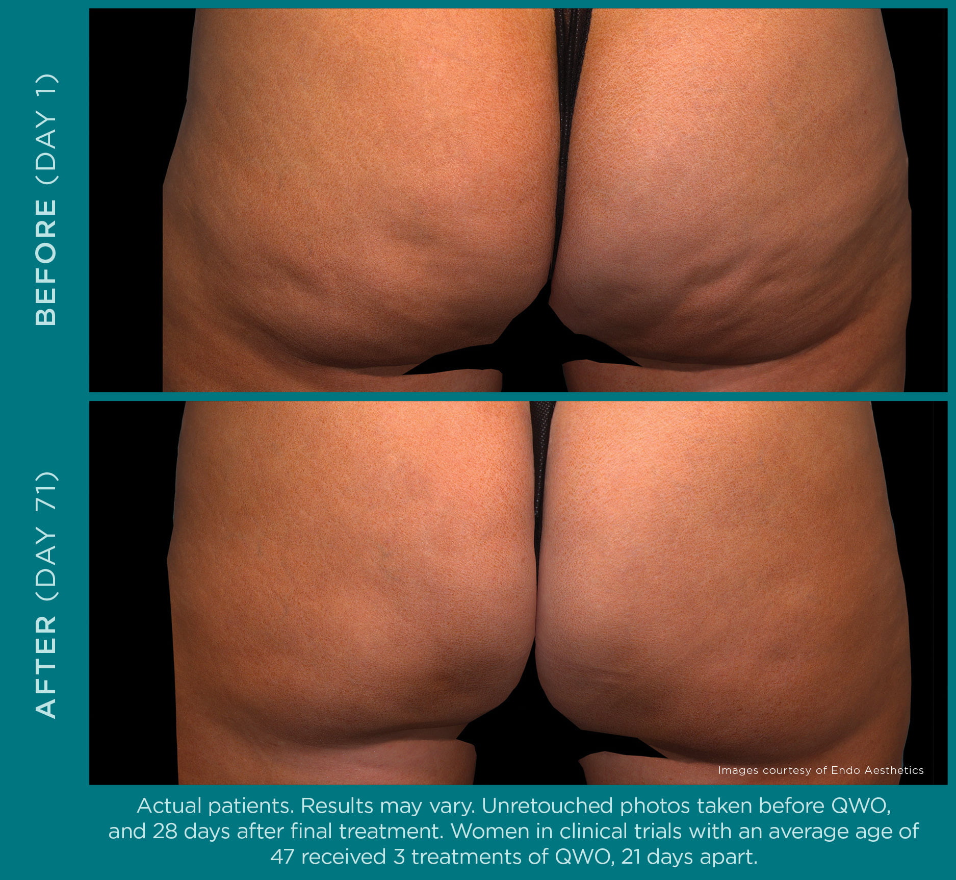 Before and After Image of QWO Treatment By GloDerma Aesthetics in Yardley, PA